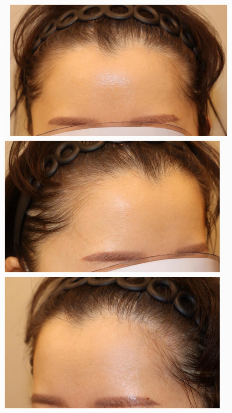 HAIRO HAIR TRANSPLANT CENTER Daegu Day 14 Hair Transplant review