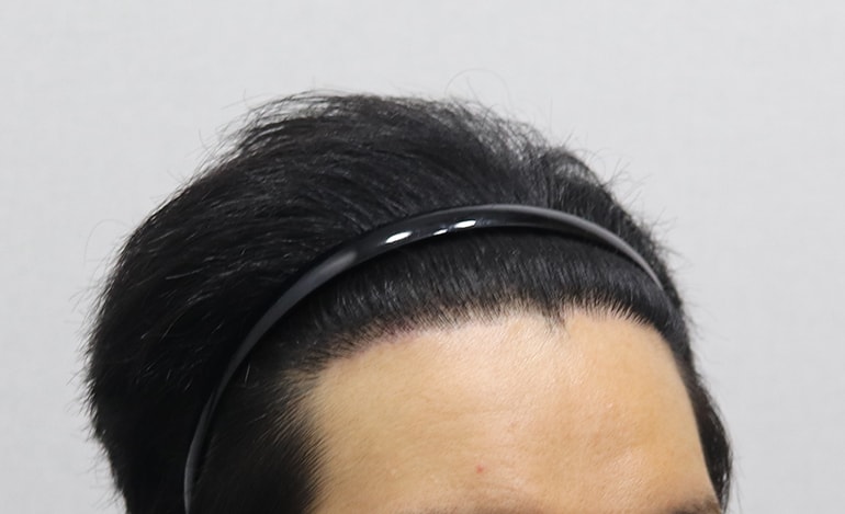 1년 우측.JPG