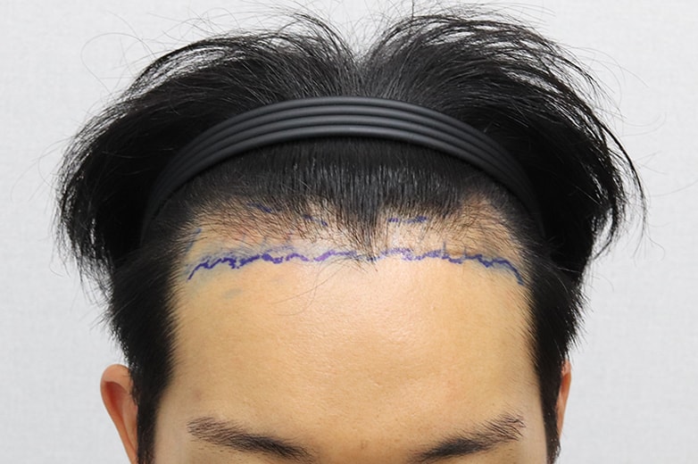 수술전디자인.jpg