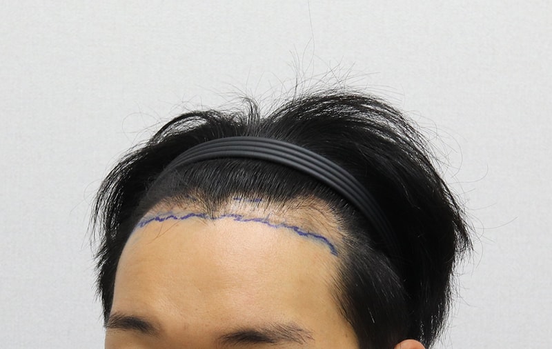 수술전 좌측.JPG