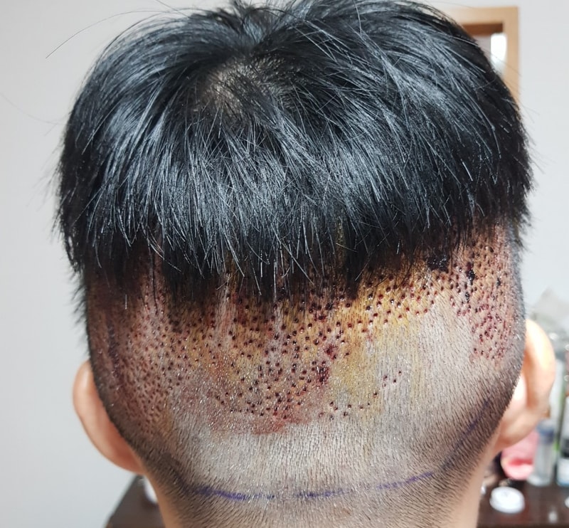드림헤어라인_비절개2800모_채취부위.jpg
