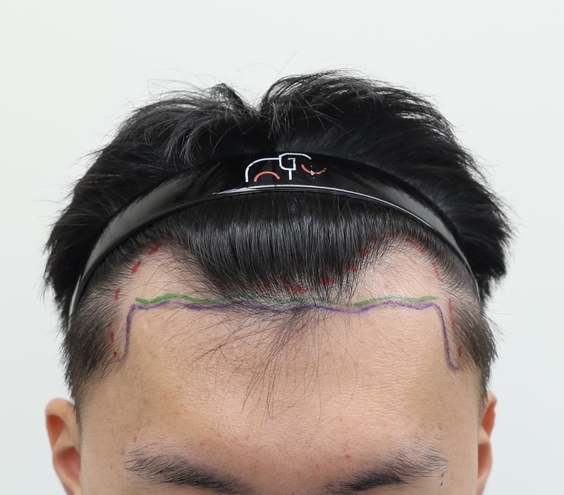 압구정 맘모스 비절개 모발이식 후기 (웃음가스 마취)