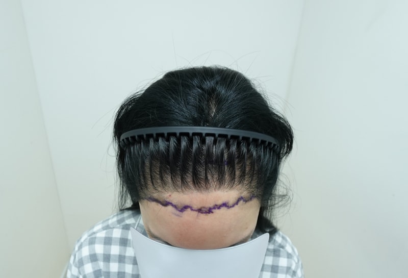 자라다의원 비절개여성 4개월 수술후기