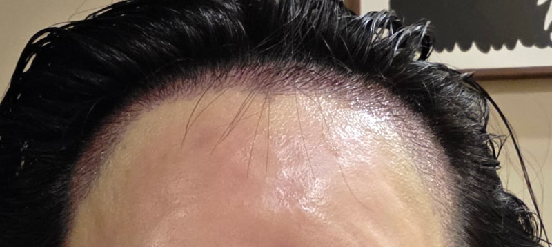 압구정 모우림의원,헤어라인 절개 후기입니다.