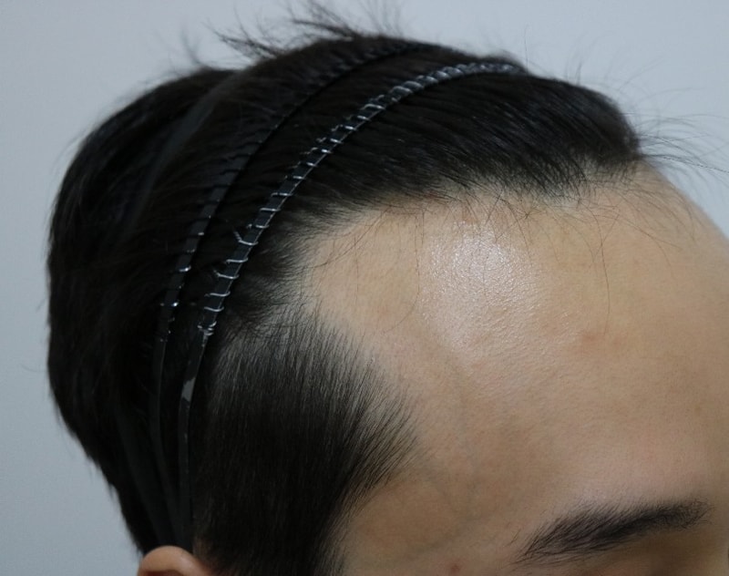 수술전 측면2.jpg