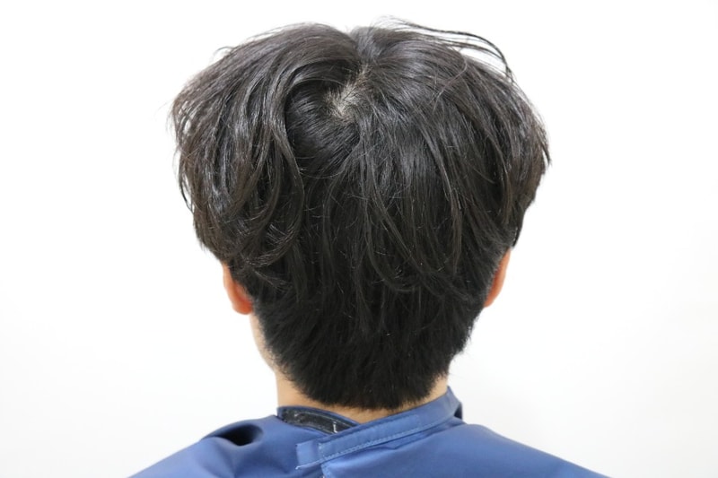 수술 후 뒷머리.jpg