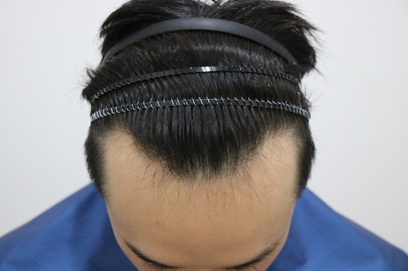 수술전 위.jpg