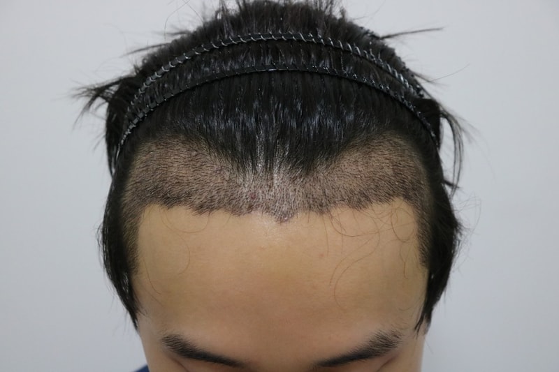 수술 2주 후 위.jpg