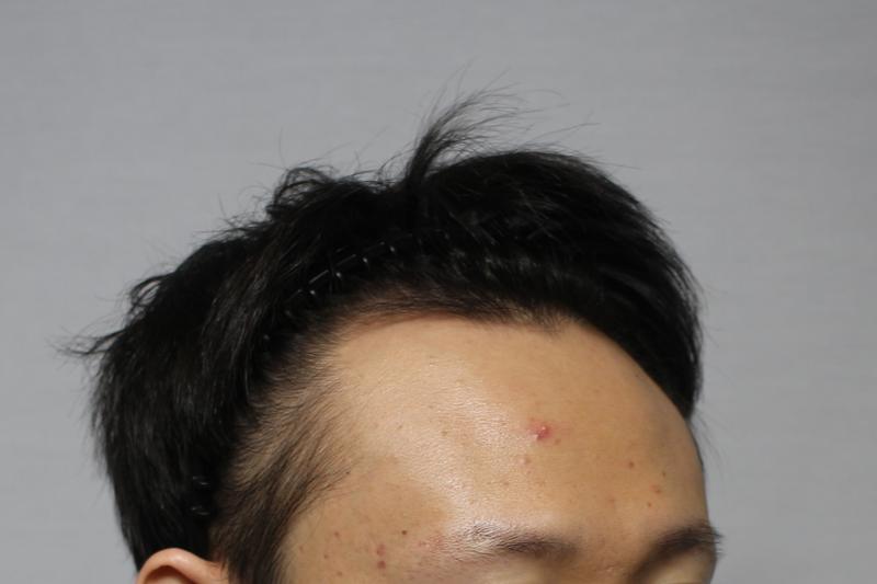 m자 헤어라인 모발이식 했습니다! / 3000모 절개 / 모아만의원 김대영