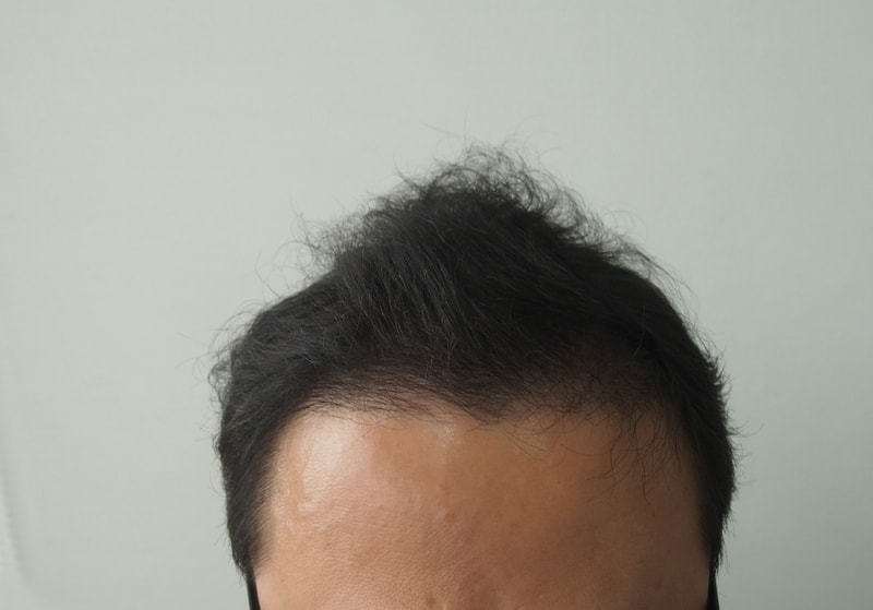 모재성 1500모낭 비절개 4개월 후기 입니다