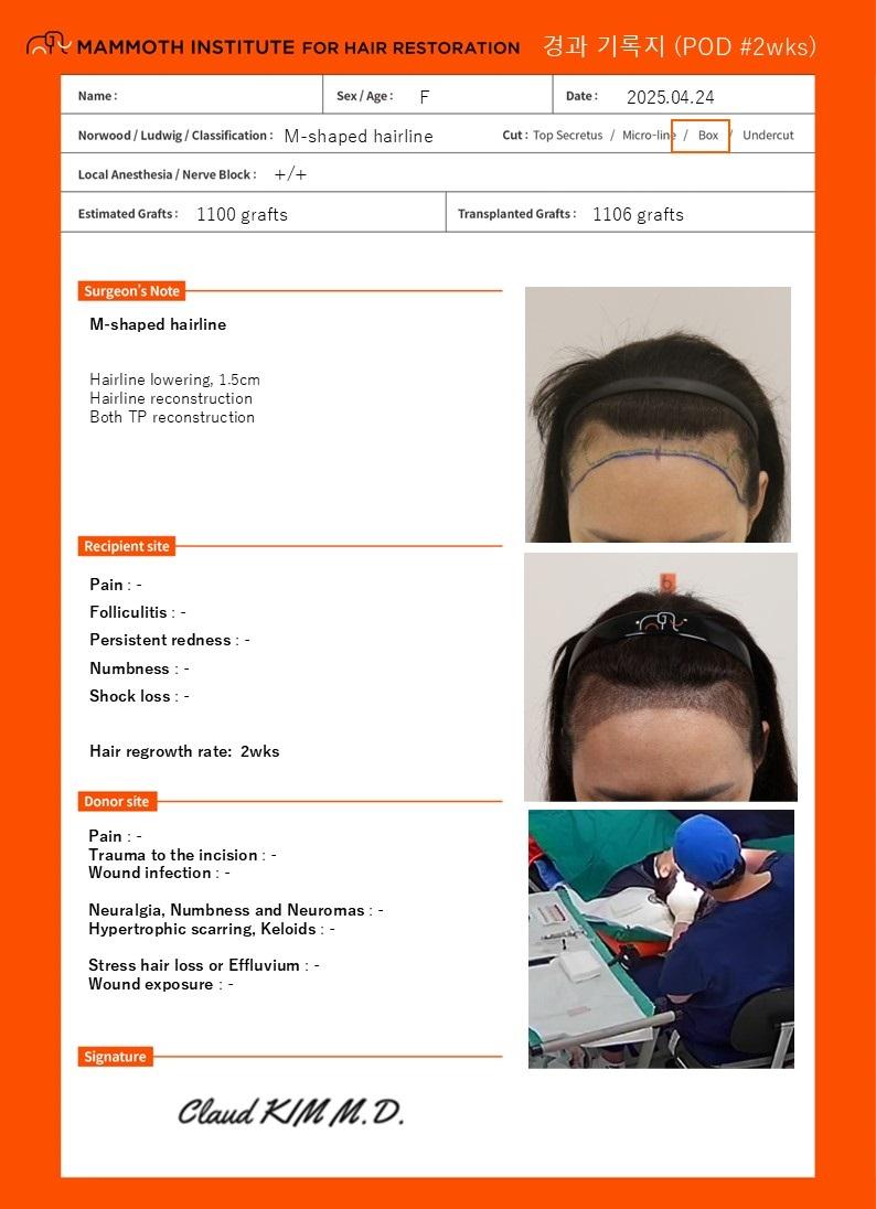 Women's hairline correction 2 weeks later at the Busan Slit Hair Transplantation Mammoth Hairline Clinic
