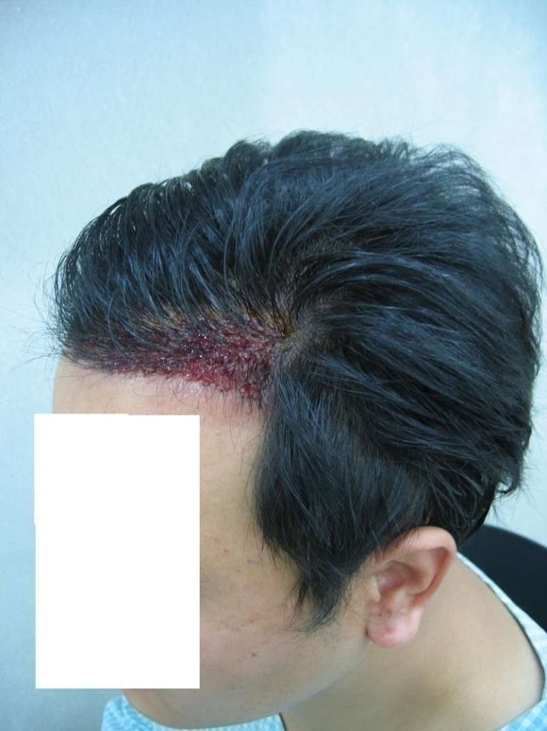 isic9.JPG