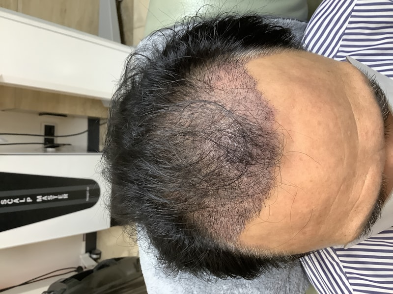 수술14일 딱지제거후1.jpg