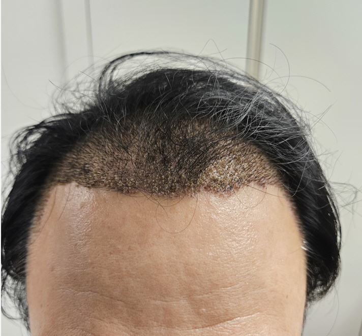 수술후5일차1.jpg