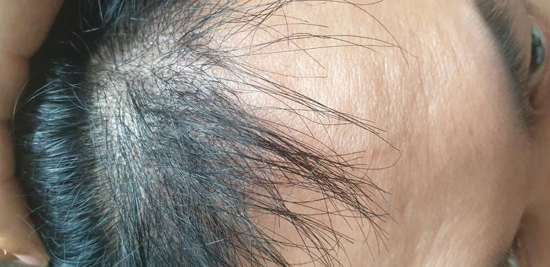 Motion M1200 hair follicles + top repair 600 hair follicles Day 131