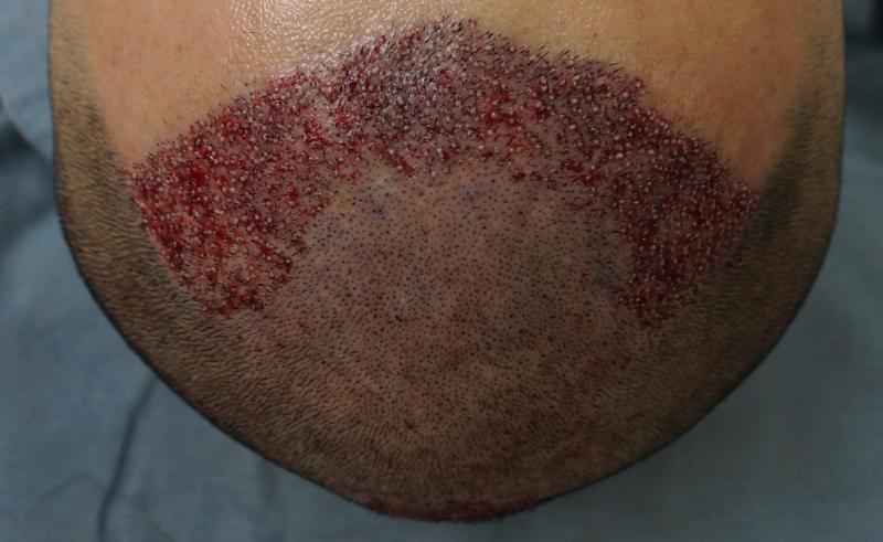 [mg]M-shaped 1200 hair follicles + 600 hair follicles on the second day of surgery.