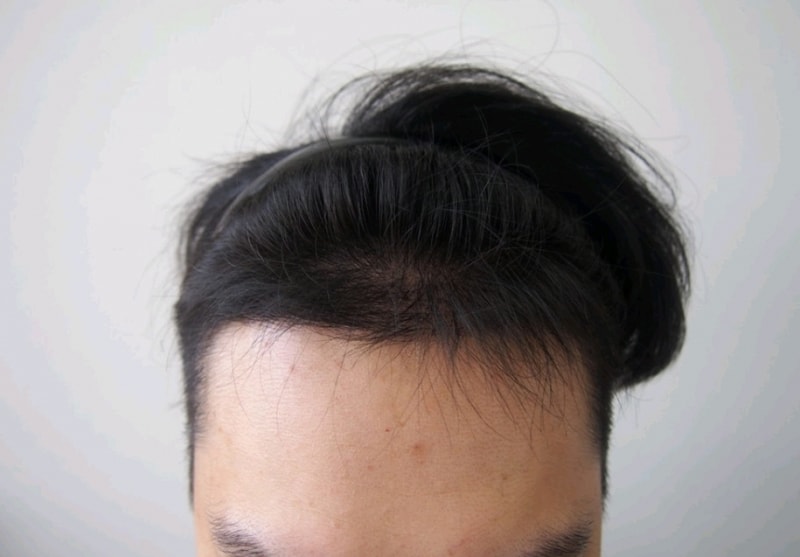 모재성 비절개 4개월 조금지난 경과