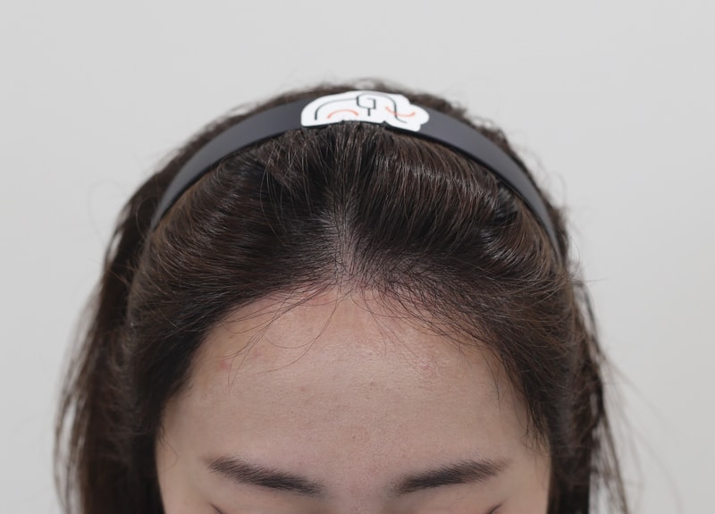 Apgujeong Mammoth 7 Months Slit Hairline Correction Major Satisfied!!!!