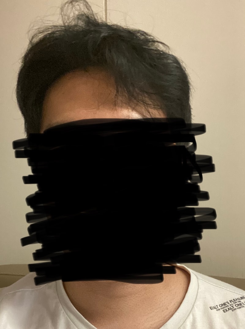 모발이식 1년차 후기입니다