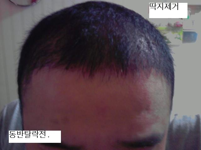 딱지제거173.jpg