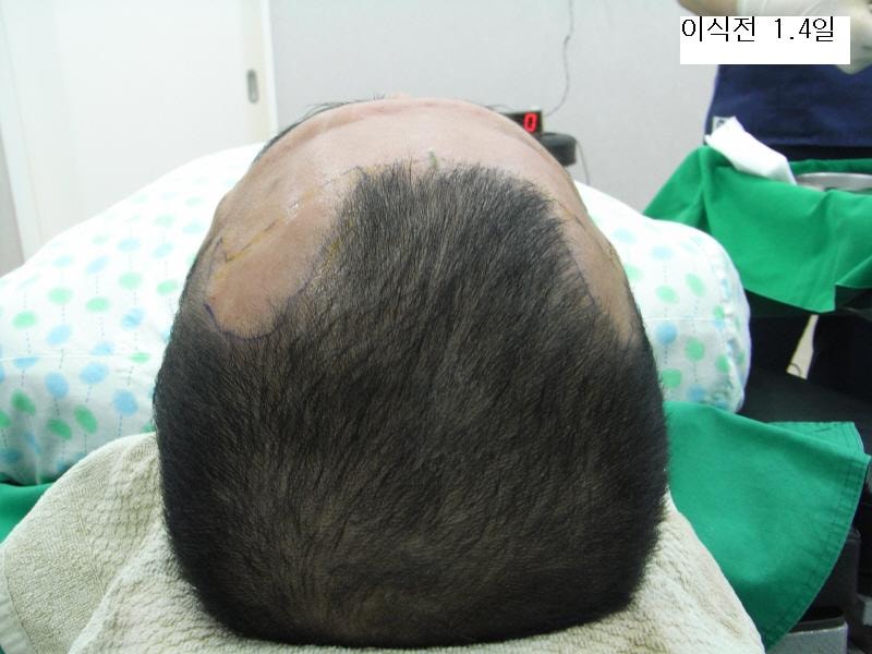 이식전1월4일.JPG