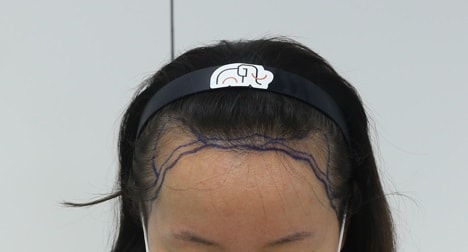 헤어라인수술전.jpg