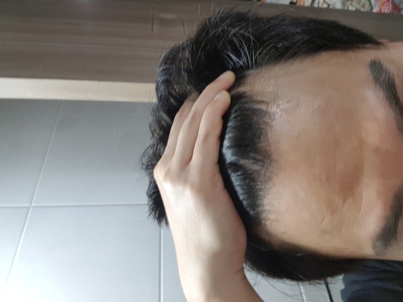 Hair transplant 1,500 hair incision