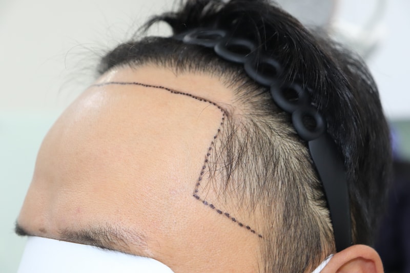 It's been a little over 6 months since I got my second hair transplant