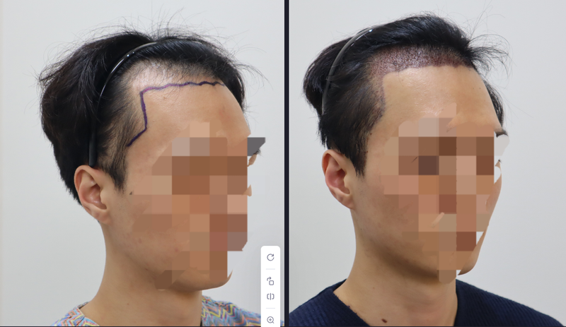 밴스모자이너의원 5000모 비절개 모발이식 뒷머리 삭발컷 남자후기