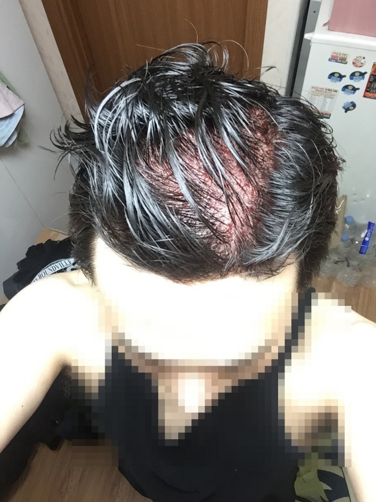수술직후.jpg
