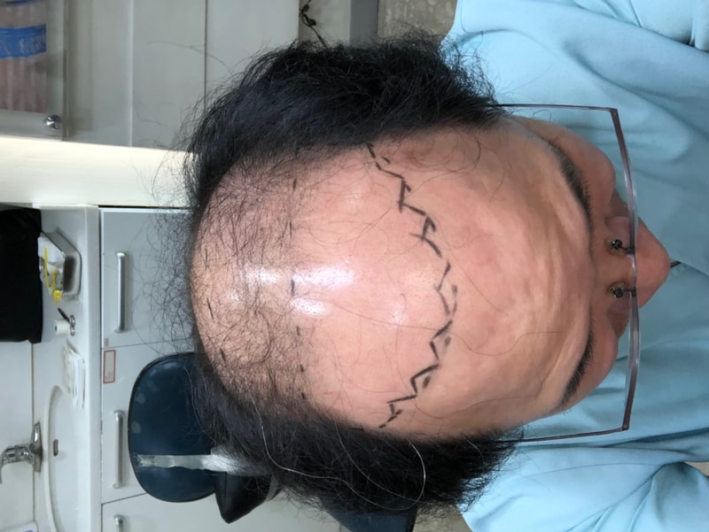 이식전.JPG