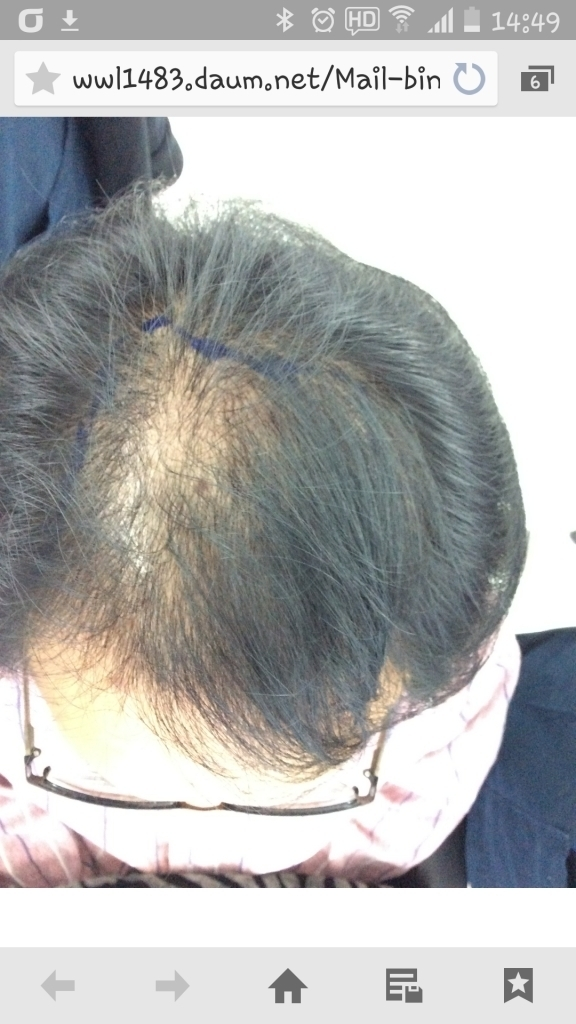 For hair 2000 hair follicle 6 months