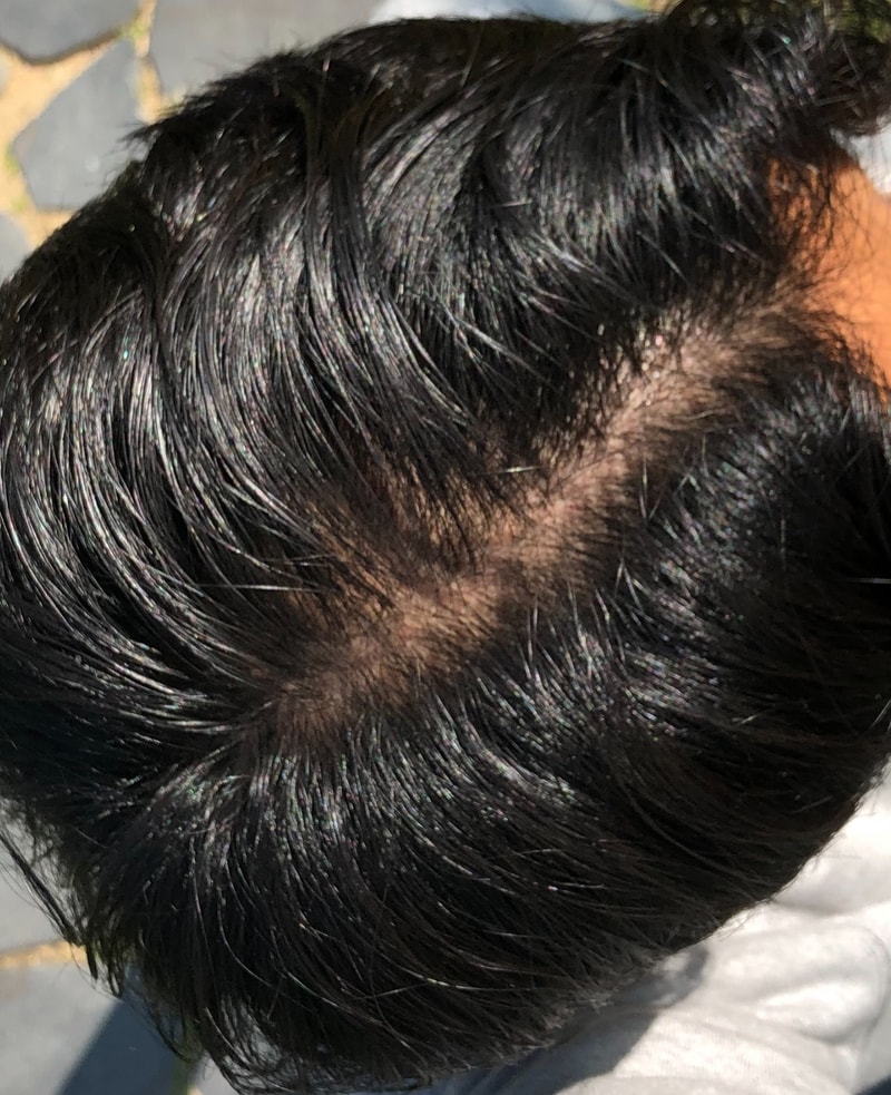 a year after parietal surgery