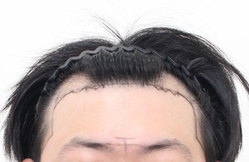 ★モプロ医院★ ヘアライン 植毛 非切開 3200毛 14日目経過
