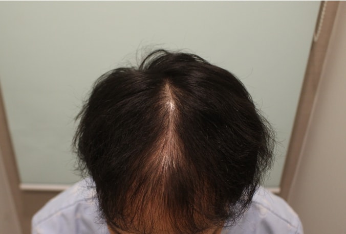 정수리 6개월차 솔직 후기