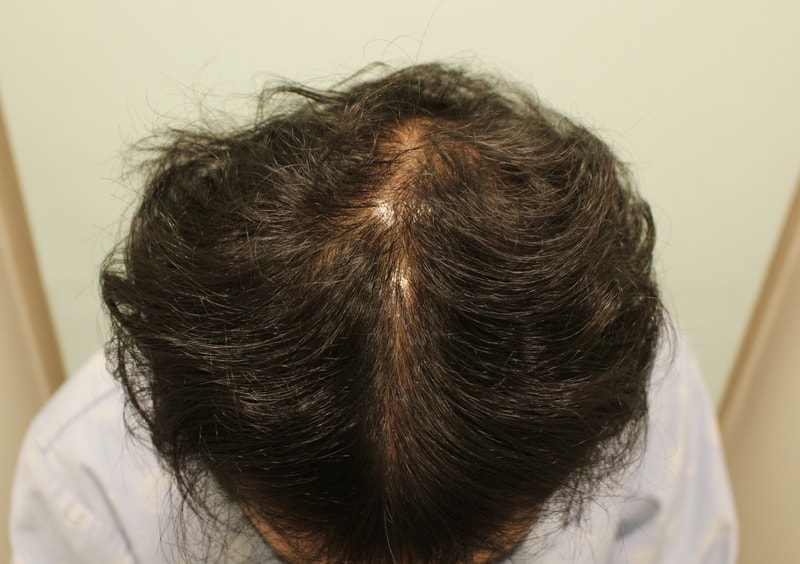 라인, 가르마(정수리) 복합 6천모