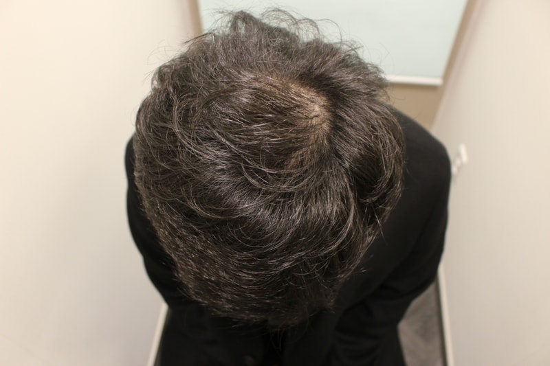 수술후 1년 3개월 1.JPG