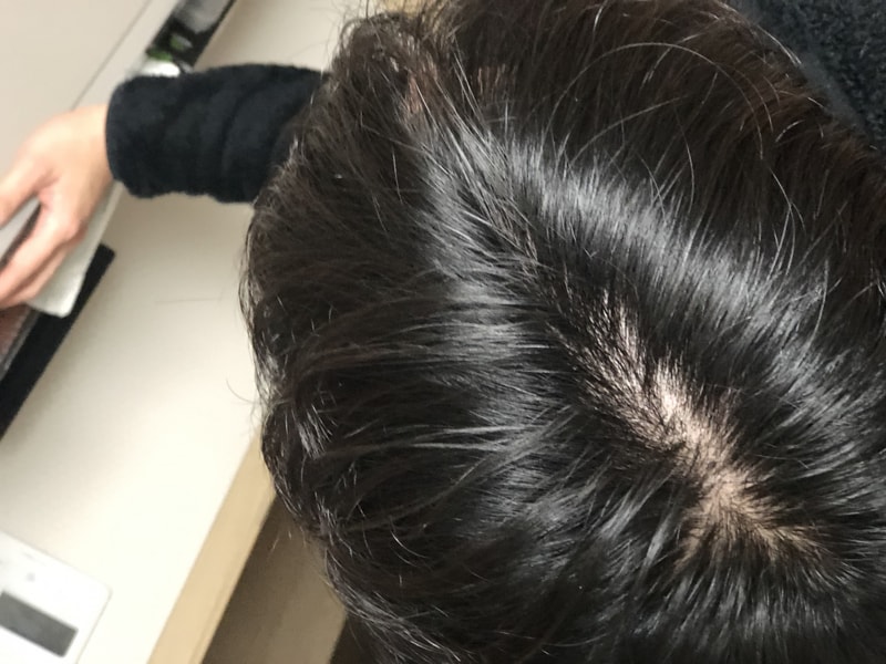 11일차 혼자서 딱지 제거 후 머리 말림.jpg