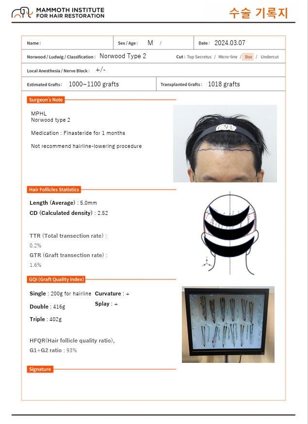 狎鴎亭 マンモス ヘアライン 医院 非切開 スリット M字 毛髪移植手術 当日レビュー