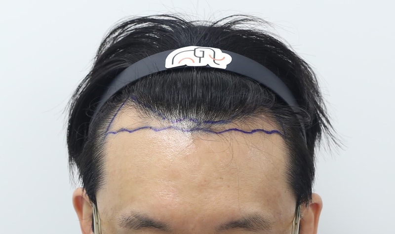 수술_2주차_02_수술전_240323.jpg