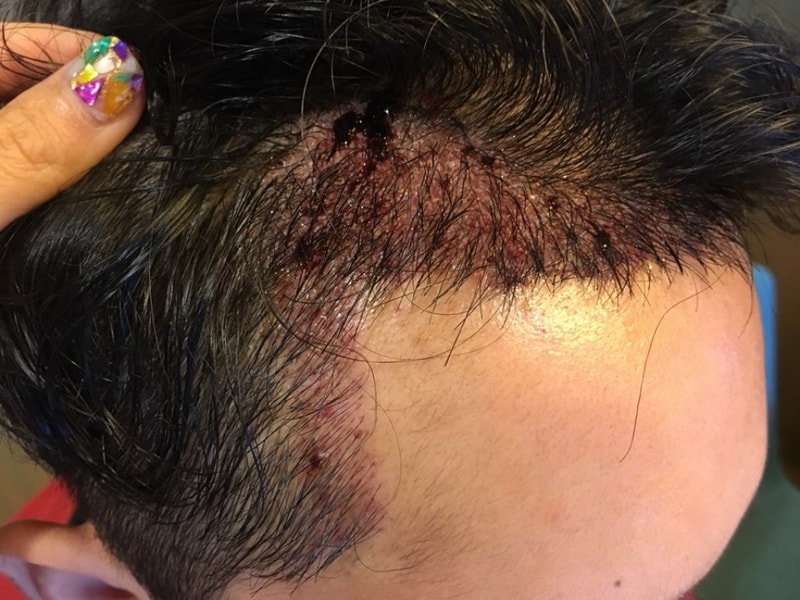 An incision/slit 1,877 hair follicle late stage.