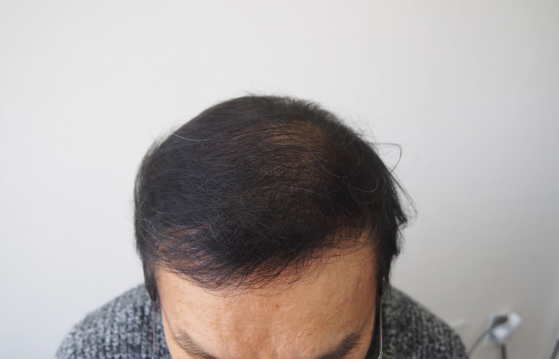 모재성모발이식센터 8개월 경과사진입니다