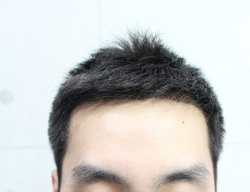 수술후이거.png