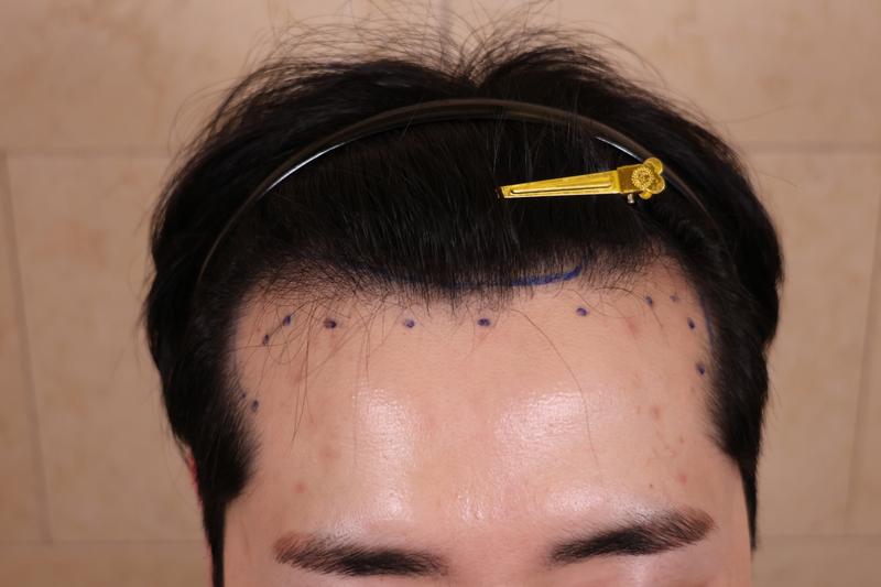 Umchan Clinic's 2500-mo hair transplant review