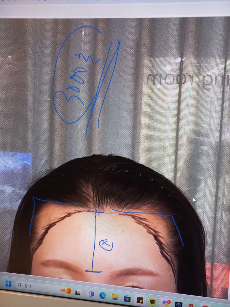 모우림 의원 절개 헤어라인 3000모 14일차 후기입니다.