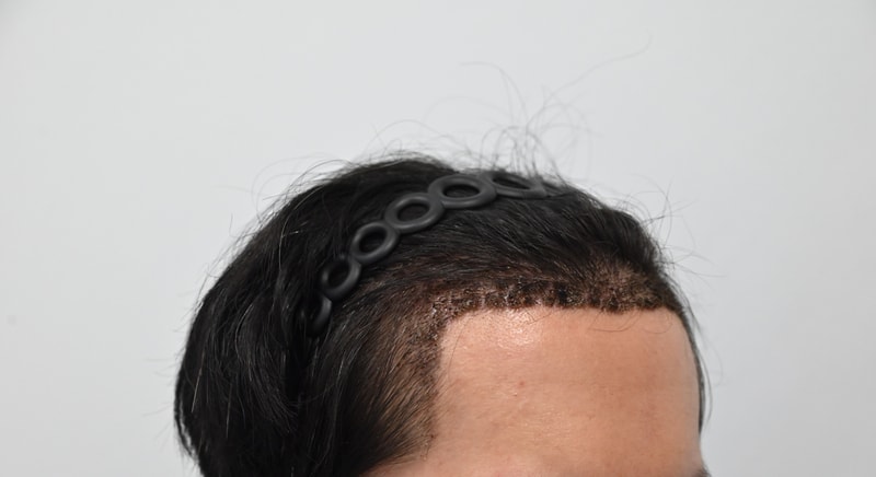 在MOEM Clinic，毛发移植已经第2周了。