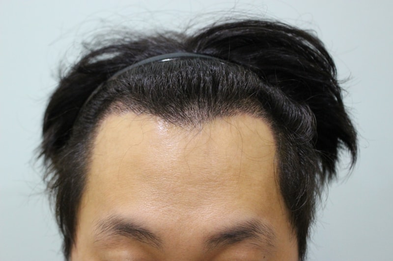 수술후 13일 (2).JPG