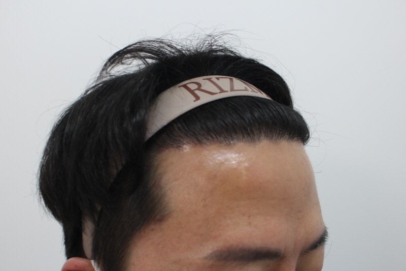 [크기변환]수술후386일차.jpg