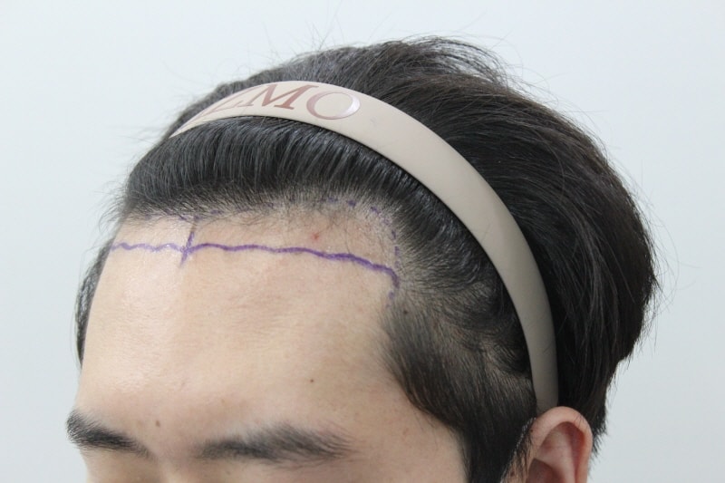수술전 옆모습.jpg