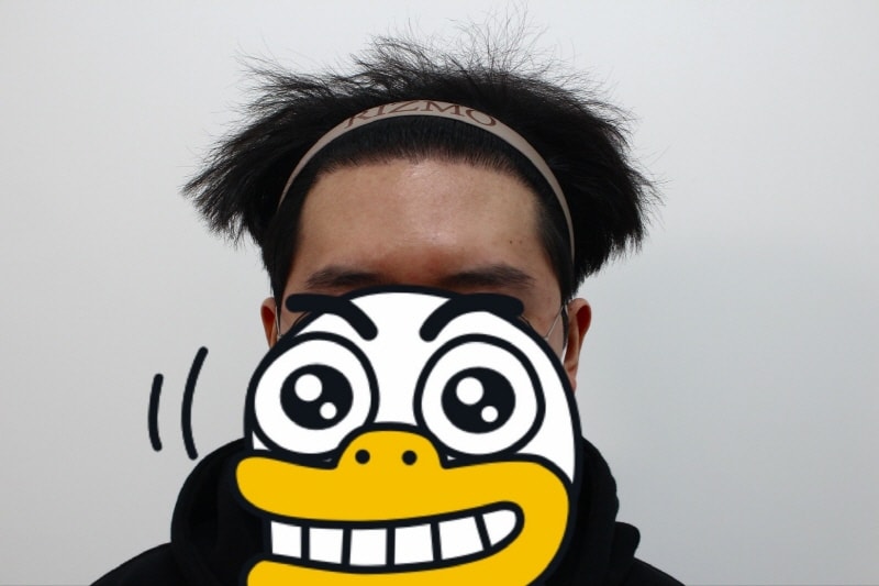 8개월 경과 헤어라인-멀리서.jpg
